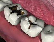 заболевания зубов